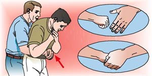 Imagen de socorrista realizndole la Maniobra de Heimlich al accidentado en posicin levantada