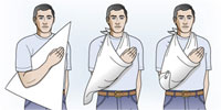 Imagen de cmo hacer un cabestrillo con una venda triangular