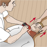 Imagen de paciente al que se le coloca un collar cervical para inmovilizacin