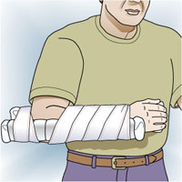 Imagen de paciente con inmovilizacin de antebrazo con frulas